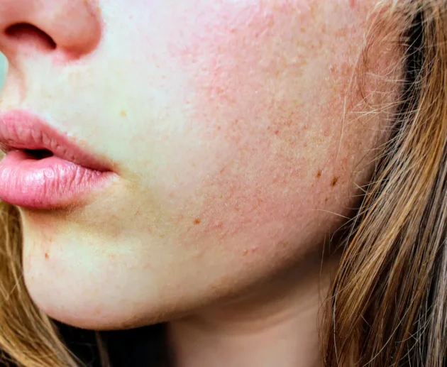 Close up of woman's face showing skin before hydrafacial treatment.