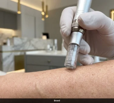 Dermapen Anwendung zur Hauterneuerung in einer Wiener Schönheitsklinik.