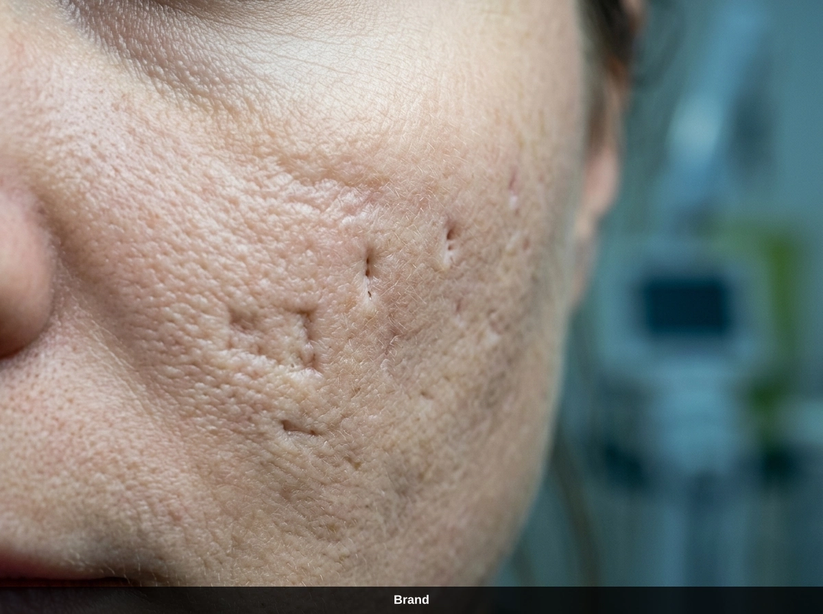 Nahaufnahme von Aknenarben im Gesicht, die durch Microneedling gegen Narben behandelt werden können.