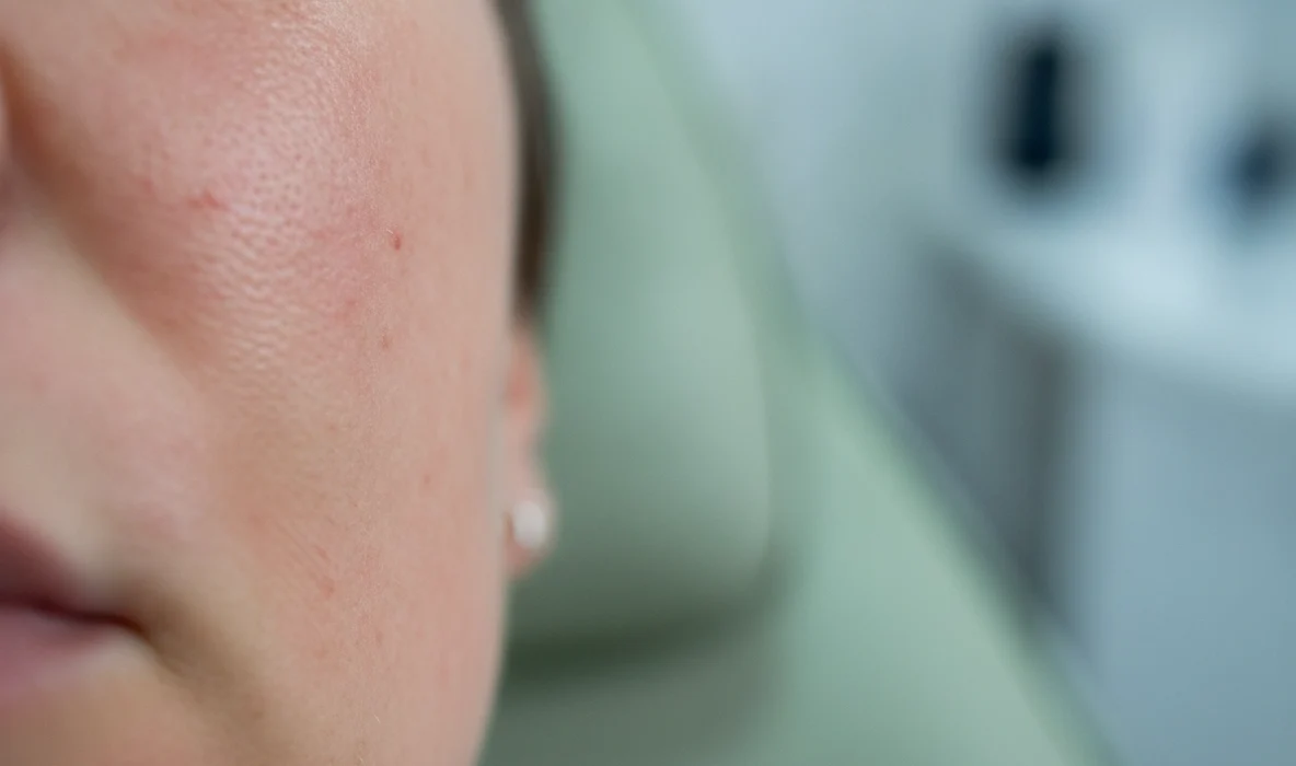 Leichte Rötung nach Microneedling im Gesicht als Teil des natürlichen Heilungsprozesses.