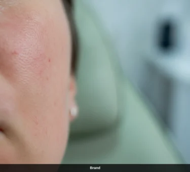 Leichte Rötung nach Microneedling im Gesicht als Teil des natürlichen Heilungsprozesses.