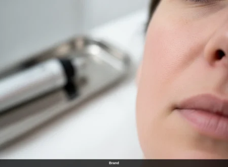 Nahaufnahme einer Hautpartie nach einer professionellen Microneedling Behandlung zur Hautregeneration.