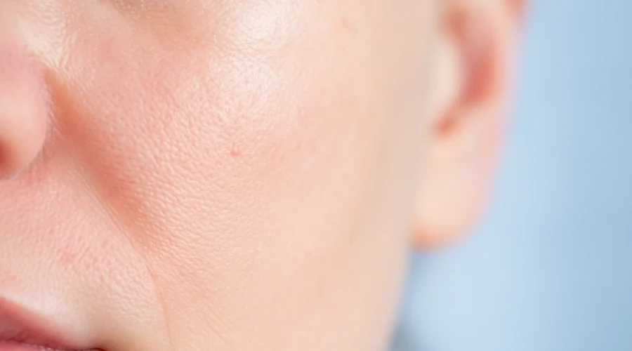 Nahaufnahme einer Hautpartie nach Mikroverletzungen durch Microneedling zur Hautregeneration.
